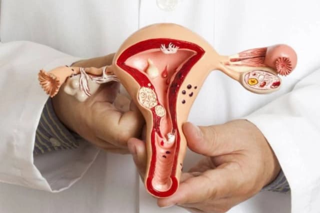 Endometrioz: sabablari, belgilari va davolash usullari